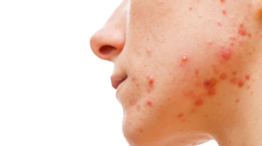 graus-e-tipos-de-acne-espinhas