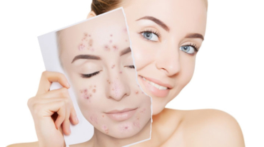 tratamento-caseiro-para-acne-funciona