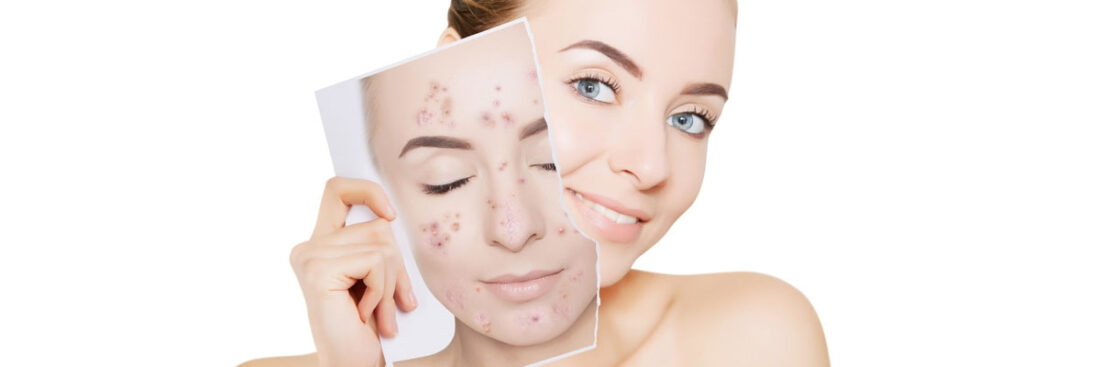 tratamento-caseiro-para-acne-funciona