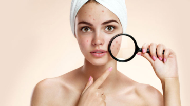 tratamento-para-acne-como-secar-espinhas