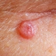 cancer-de-pele-carcinoma-basocelular