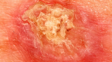 cancer-de-pele-carcinoma-espinocelular-cec