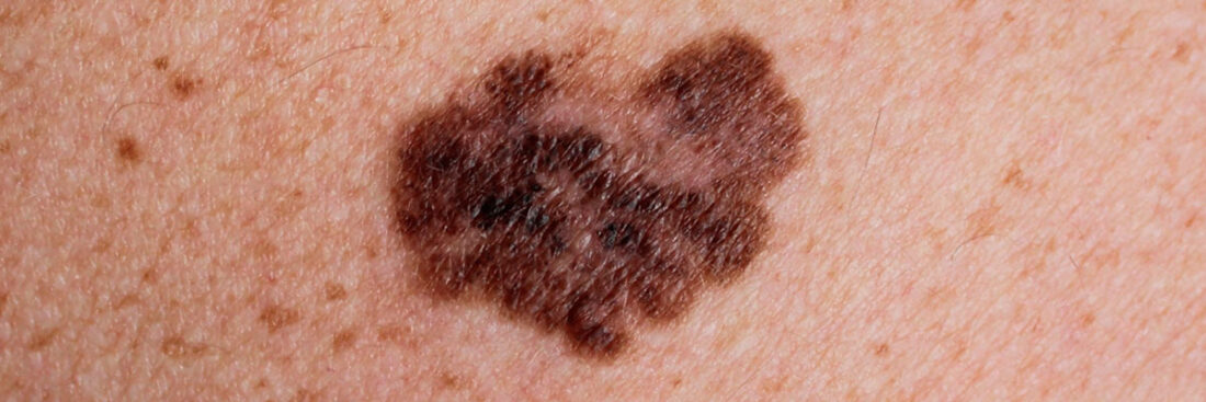 cancer-de-pele-melanoma
