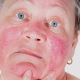 rosacea-causas-sintomas-e-tratamento