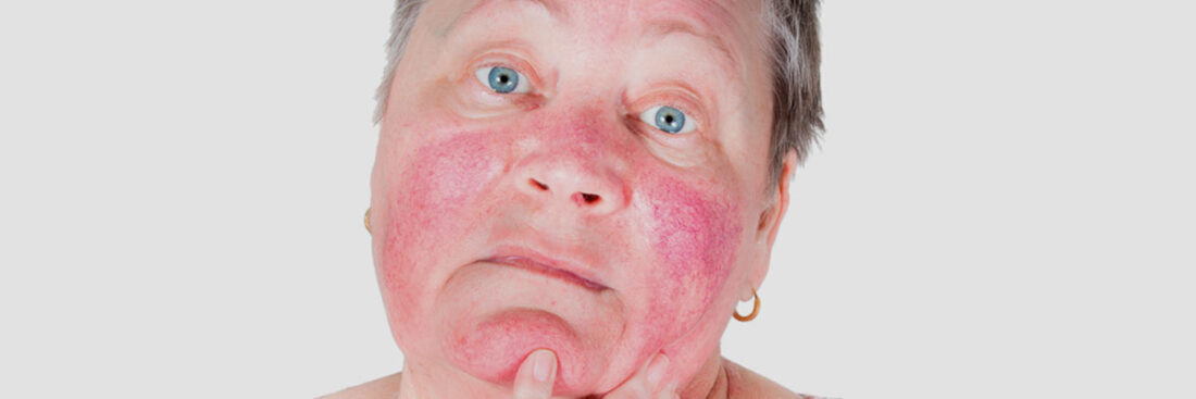 rosacea-causas-sintomas-e-tratamento