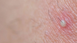 cortou-seu-cabelo-recentemente-e-sentiu-bolinhas-entenda-a-foliculite