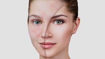 acne-espinhas