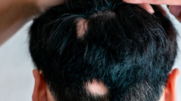 alopecia-areata-causas-sintomas-tratamento
