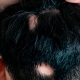 alopecia-areata-causas-sintomas-tratamento