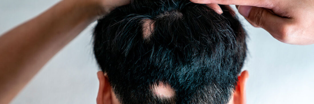 alopecia-areata-causas-sintomas-tratamento