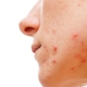graus-e-tipos-de-acne-espinhas
