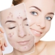 tratamento-caseiro-para-acne-funciona
