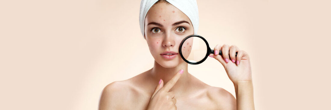 tratamento-para-acne-como-secar-espinhas