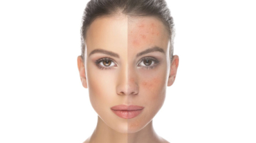 tudo-sobre-acne