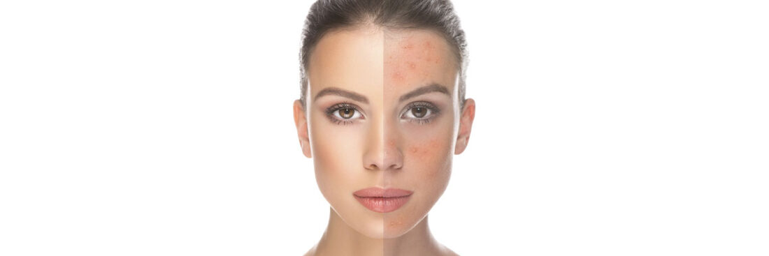 tudo-sobre-acne