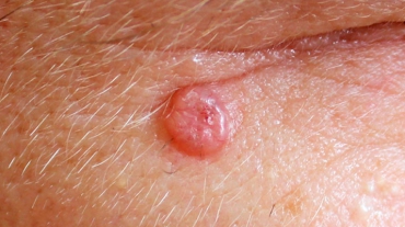 cancer-de-pele-carcinoma-basocelular