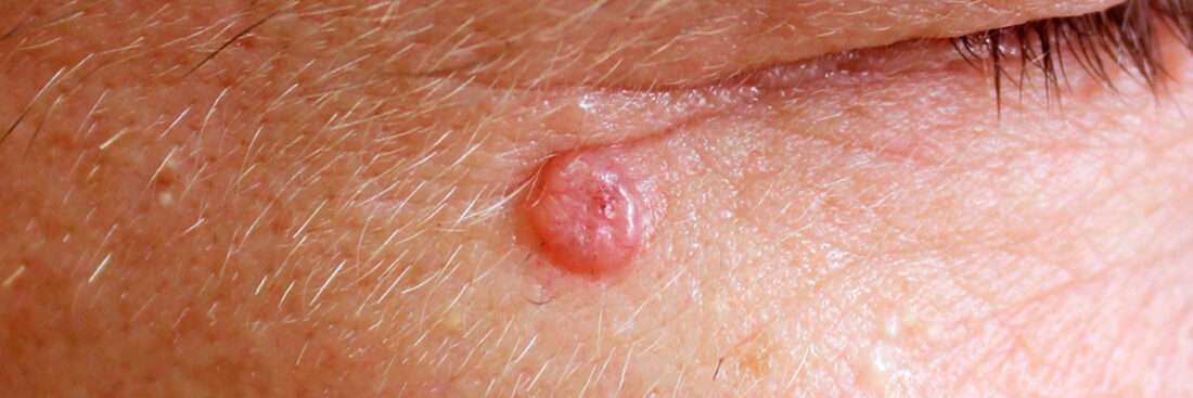cancer-de-pele-carcinoma-basocelular