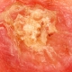 cancer-de-pele-carcinoma-espinocelular-cec