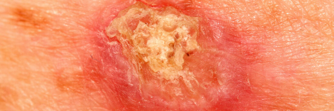 cancer-de-pele-carcinoma-espinocelular-cec