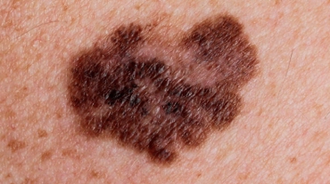 cancer-de-pele-melanoma