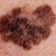 cancer-de-pele-melanoma