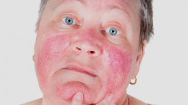 rosacea-causas-sintomas-e-tratamento