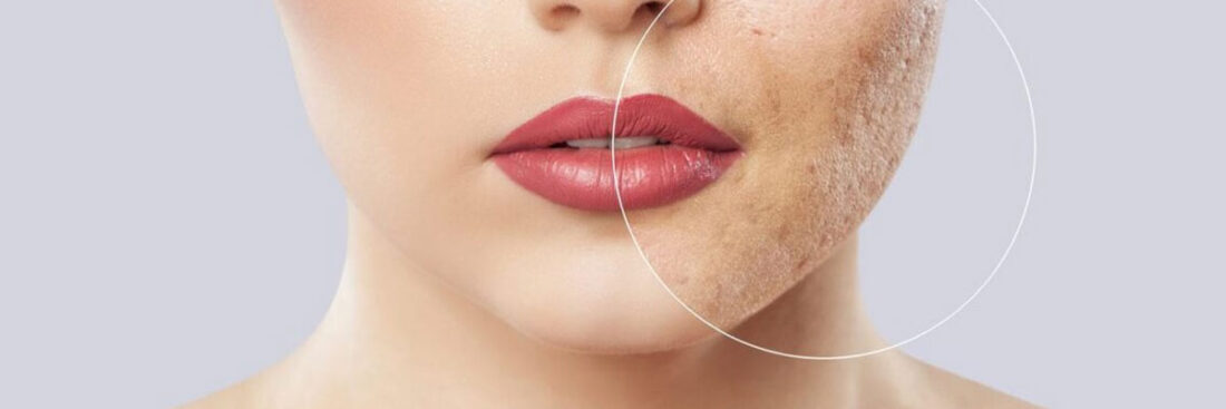 Qual o melhor tratamento para acne na adolescência?