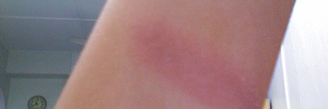 Queimadura após depilação a laser